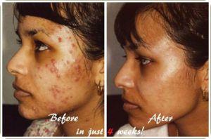 Como Eliminar El Acne Severo Naturalmente De La Cara