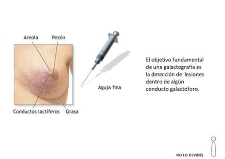 Técnica de realización de la galactografia