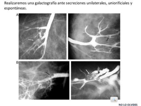 Técnica de realización de la galactografia