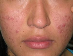 Como Eliminar El Acne Definitivamente Hoy Como Eliminar El Acne Definitivamente Hoy