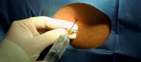 Punción lumbar: riesgos y complicaciones