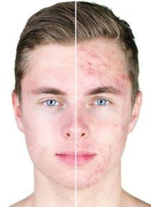Como Sacar El Acne En Un Dia – Lo Que Ningún Médico Te Compartirá
