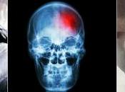 Anosognosia