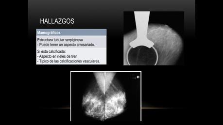 ENFERMEDAD DE MONDOR ENFERMEDAD DE MONDOR