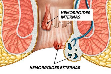 Mejores remedios caseros para las hemorroides