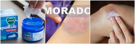 Eliminar los moratones con Vicks Vaporub