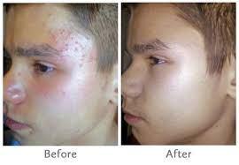 5 Remedios Para El Acne Seguros y Muy Efectivos