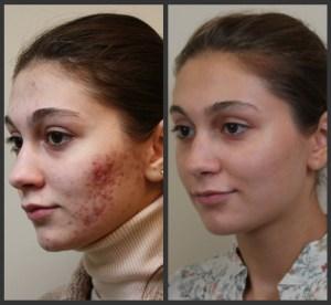 Que Remedios Caseros Hay Para El Acne – Descúbrelo Ahora