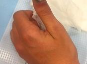 Hematoma subungueal: como actuar?