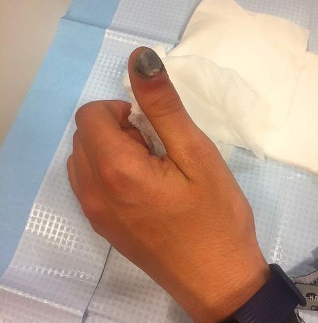Hematoma subungueal: como actuar?