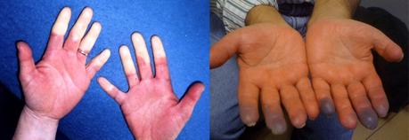 VIVIR CON LUPUS - Síntomas principales del Lupus / www.facebook.com/ElLibroGordoDeLaVida VIVIR CON LUPUS - Síntomas principales del Lupus / www.facebook.com/ElLibroGordoDeLaVida