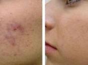 Como Quitar Acne Rapido Posible