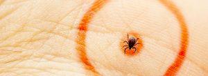 5 Terapias alternativas peligrosas para la enfermedad de Lyme crónica 7 Señales de que podría tener la enfermedad de Lyme crónica