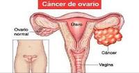 El Cáncer de Ovario es difícil de detectar en sus Primeras Etapas
