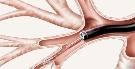 Broncoscopia procedimiento