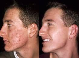 Como Quitarme El Acne En Un Dia En Tres Pasos Como Quitarme El Acne En Un Dia En Tres Pasos
