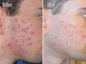 Como Quitar El Acne Severo Rapido En Casa