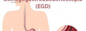 Esofagogastroduodenoscopia: que esperar de EGD