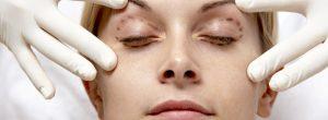 Blefaroplastia o cirugía de párpados: ¿qué esperar?