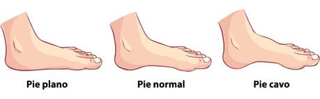 Pie plano Diagnóstico de pies planos