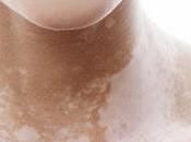 Vitiligo Como Cura