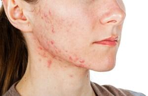 Como Quitar El Acne Por Completo