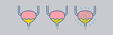Tipos de infección de orina