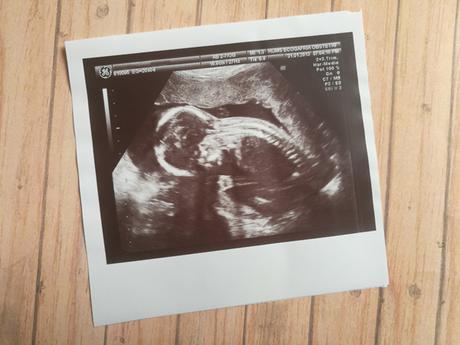 Ecografía de 12 semanas ¿Cómo es? ¿Se verá el sexo del bebé? Fin del primer trimestre del embarazo