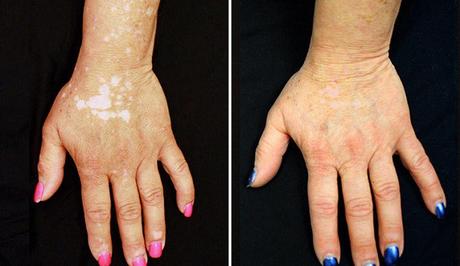 solucion al vitiligo antes y despues de las manchas 