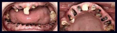 efectos del cristal boca meth