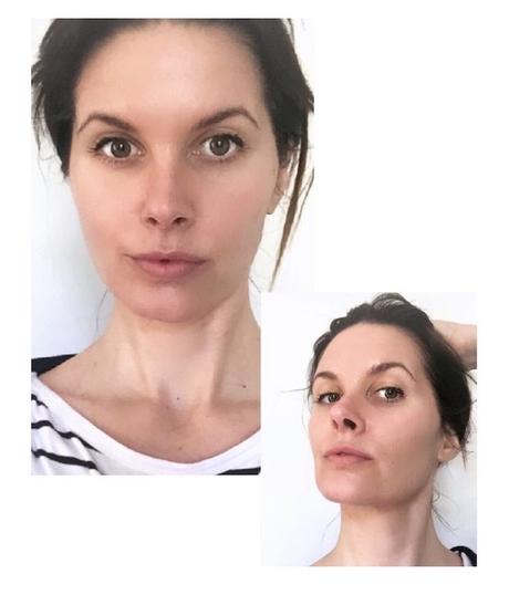 radiofrecuencia onix maria padilla 3a sesion