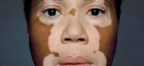 vitiligo en la cara