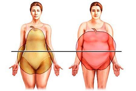 Obesidad Tipos de obesidad