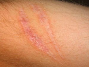 5 consecuencias graves de los chupetones 5 consecuencias graves de los chupetones
