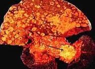 Nuevo Tratamiento para el Cancer Pancreatico