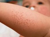Dermatitis sarpullido cuerpo bebé