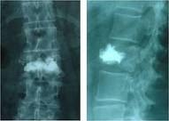 La Cifoplastia o Vertebroplastia