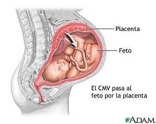 Los citomegalovirus pueden afectar al bebé en el útero materno