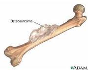 El osteosarcoma