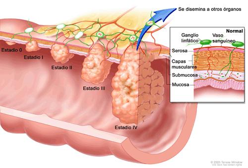 Prevenir el cáncer de colon