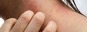 Sudoración excesiva en el área de glúteos: ¿y ahora qué? Poltuberancias que exuda líquido