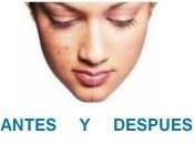 Como Quitar Acne Facil Rapido
