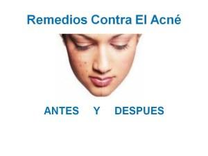 Como Quitar El Acne Facil y Rapido