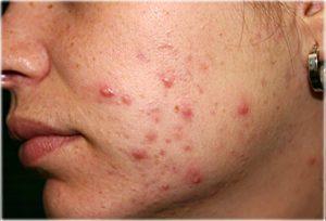 Como Quitar El Acne Por Estres