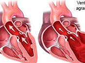 Cardiomegalia