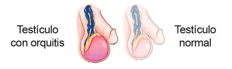 Qué es la orquitis