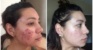 Como Quitar El Acne Vulgar Como Quitar El Acne Vulgar