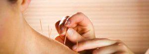La acupuntura para la artritis reumatoide: qué esperar en su primera visita