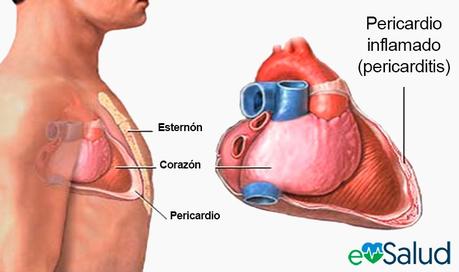 Causas de la pericarditis