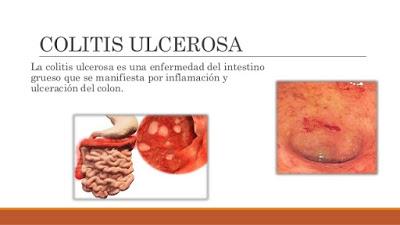 COLITIS ULCERATIVA, PUEDE AFECTAR A CUALQUIER GRUPO DE EDAD COLITIS ULCERATIVA, PUEDE AFECTAR A CUALQUIER GRUPO DE EDAD